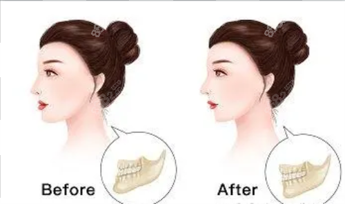 正頜手術(shù)后的成效圖片