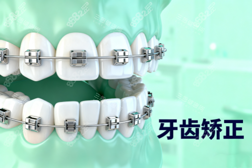 傳統(tǒng)牙齒矯正方式展示