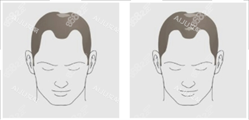 發(fā)際線及頭頂頭發(fā)脫落素材