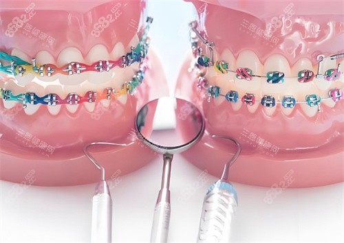 牙齒矯正模型圖片