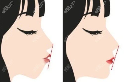 正頜手術(shù)前后的對比圖