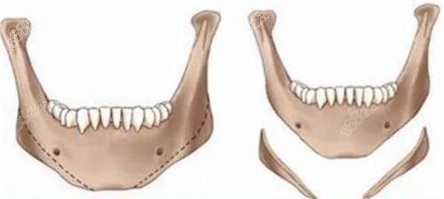 下頜角削骨前后對比