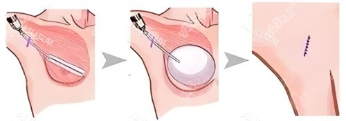 假體隆胸術(shù)圖 假體隆胸術(shù)圖