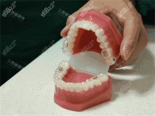 牙齒矯正隱形牙套模型展示示意圖