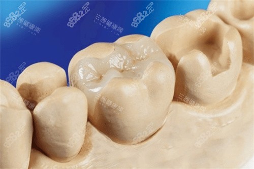 補牙嵌體修復結果