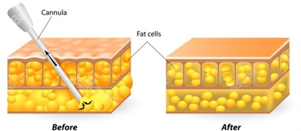 花了20萬找馮斌吸脂是真的很值不會(huì)反彈
