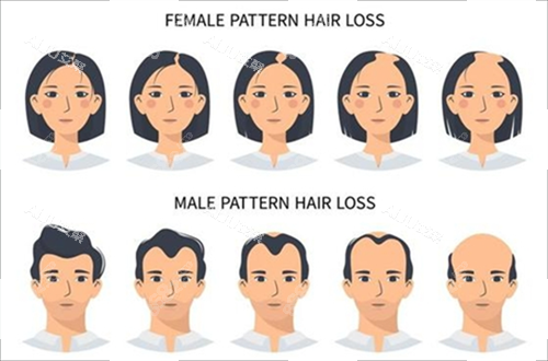 男女生發(fā)際線對比