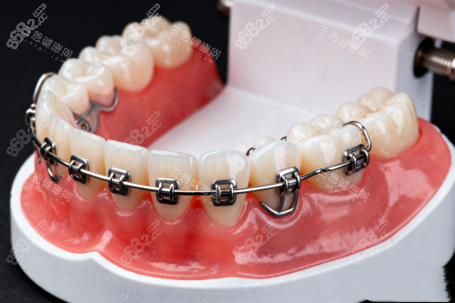 傳統(tǒng)牙齒矯正器模型展示
