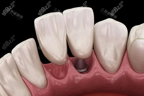 種植牙一拖二內(nèi)部展示圖