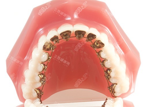 牙齒矯正金屬舌側(cè)矯正牙套模型