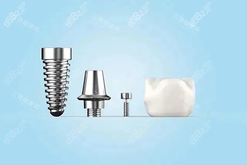 種植牙不同部件模型示意圖