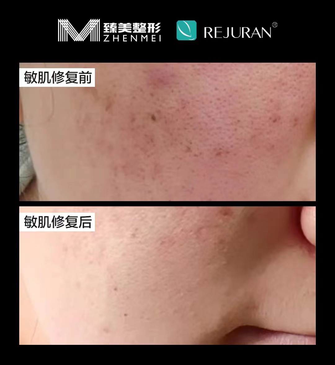 赴韓打麗珠蘭藍(lán)盒的避坑指南：正版驗(yàn)證與施術(shù)頻次的科學(xué)建議