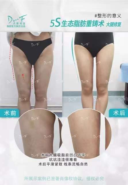 為什么選擇馮斌醫(yī)生做吸脂/脂肪填充？