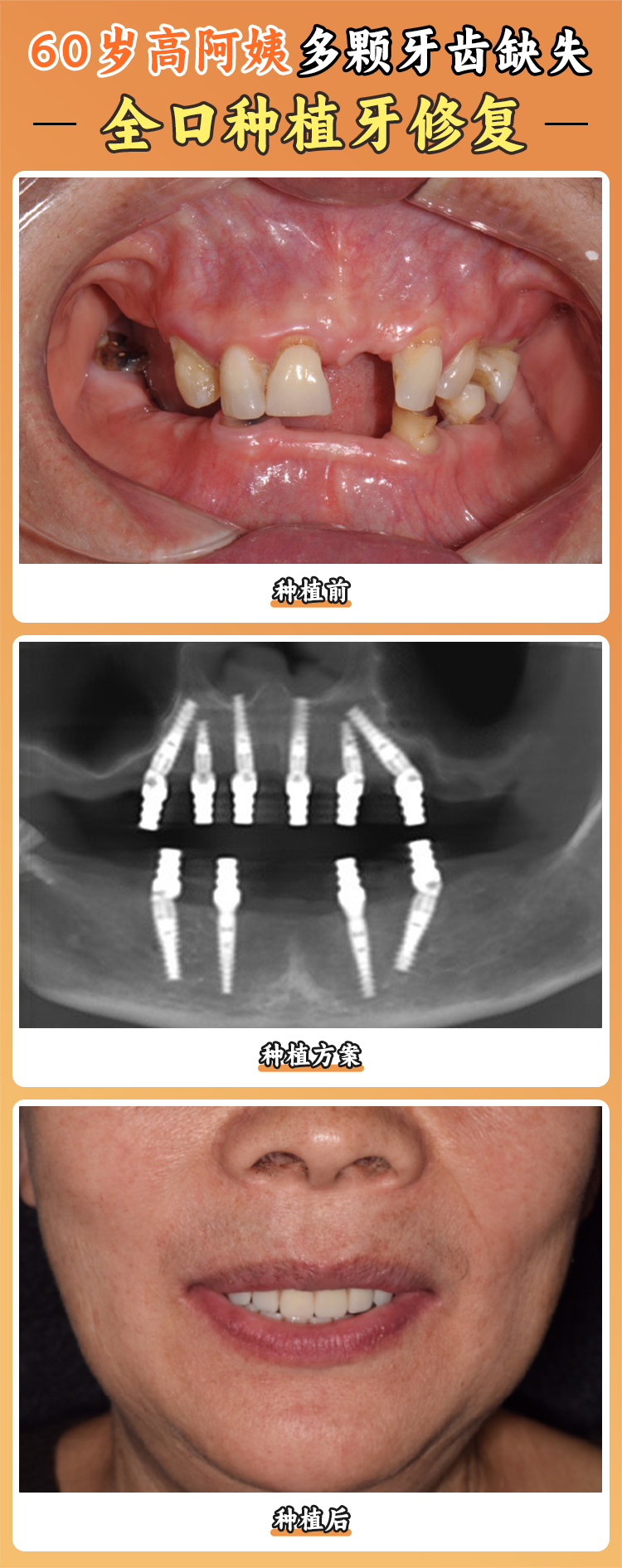 三、萬維普惠口腔種植技術(shù)與設(shè)備——種植可靠的技術(shù)支撐www.sorencai.cn