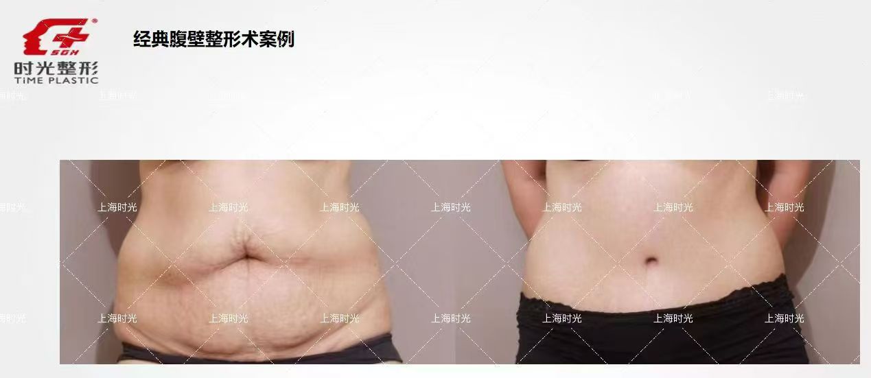 顧云鵬腰腹環(huán)吸真實價格揭秘www.sorencai.cn