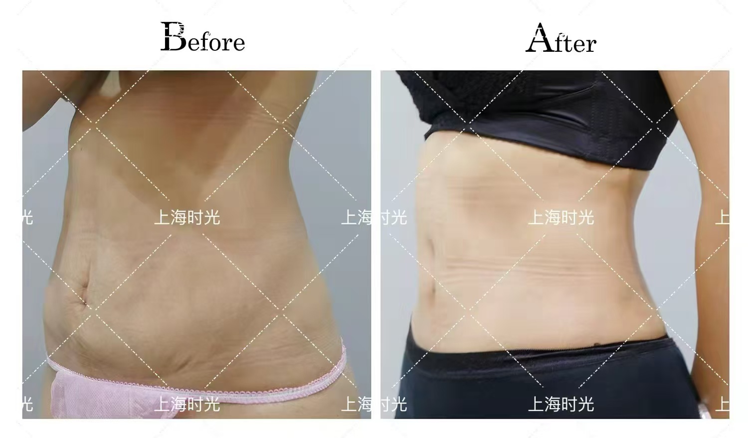 顧云鵬腰腹環(huán)吸術(shù)后修復(fù)情況