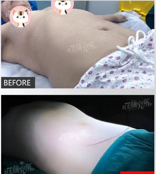 顧云鵬腰腹環(huán)吸預(yù)約流程及注意事項