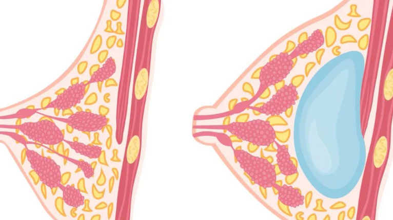三、傅少梅醫(yī)生做注射隆胸手術(shù)就診及詢價小貼士www.sorencai.cn
