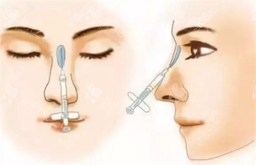 隆鼻材料注射 隆鼻材料注射