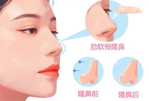 超肋骨隆鼻整形手術(shù)卡通圖