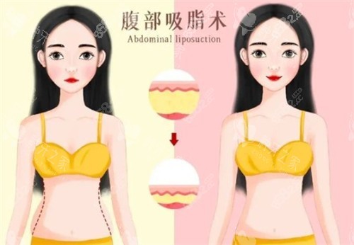 吸脂前后對(duì)比