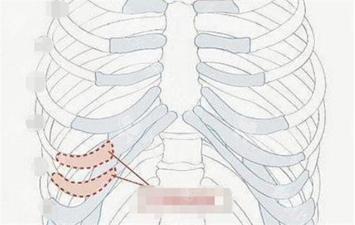 肋軟骨隆鼻肋部位置展示圖 肋軟骨隆鼻肋部位置展示圖