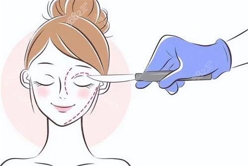 雙眼皮手術(shù)設(shè)計(jì)