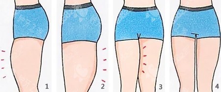 大腿吸脂卡通圖