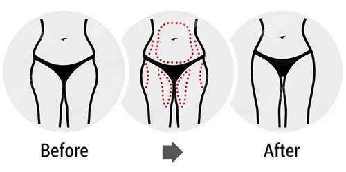 腰腹大腿吸脂前后對(duì)比圖