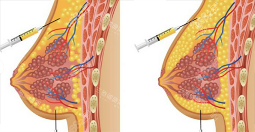 胸部奧美定注射物