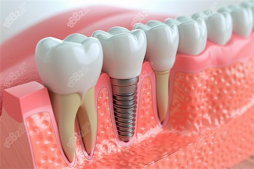 種植牙與正常牙齒模型對比漫畫圖