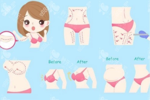 吸脂塑形卡通概念圖