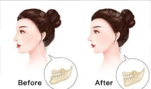 正頜手術(shù)后的成效圖片