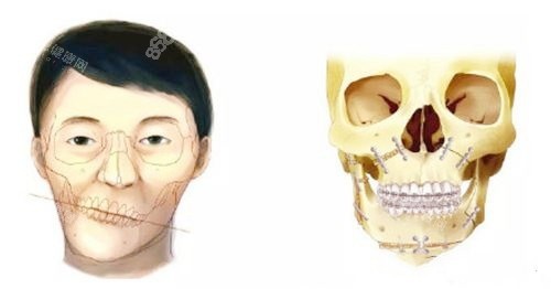 正頜手術(shù)對比圖