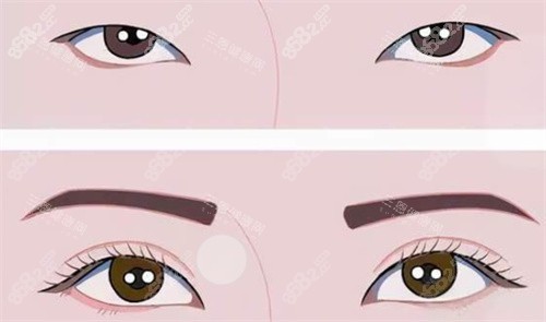 雙眼皮前后對比