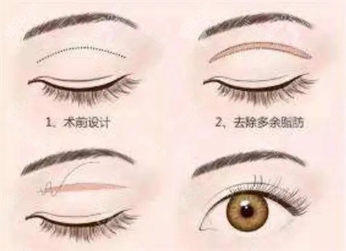 全切雙眼皮卡通示意圖