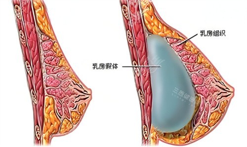 假體隆胸術(shù)原理圖