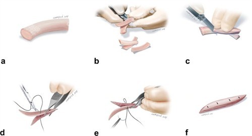 雕刻鼻整形填充物