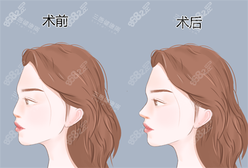 鼻整形手術(shù)對比