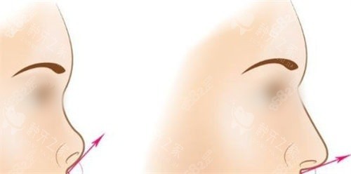 隆鼻手術(shù)鼻尖角度調(diào)整前后對比圖 隆鼻手術(shù)鼻尖角度調(diào)整前后對比圖