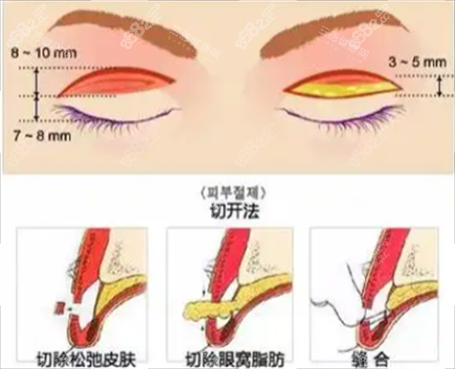 切開雙眼皮手術(shù)