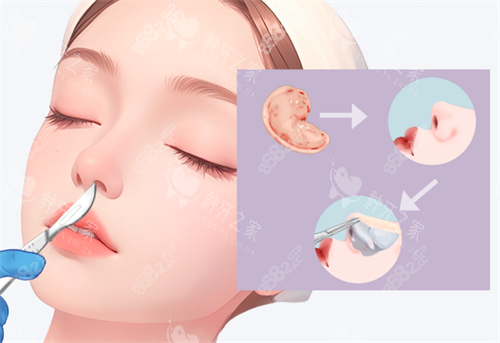 隆鼻手術(shù)過程 隆鼻手術(shù)過程