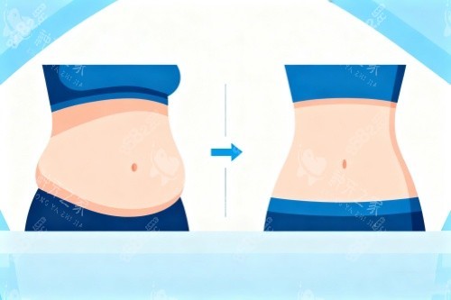 腰腹部做吸脂卡通圖