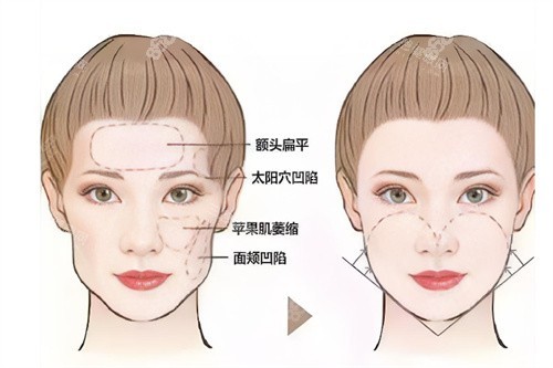 面部輪廓填充前后對(duì)比