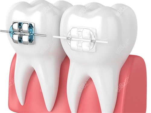 牙齒矯正金屬托槽及陶瓷托槽漫畫圖