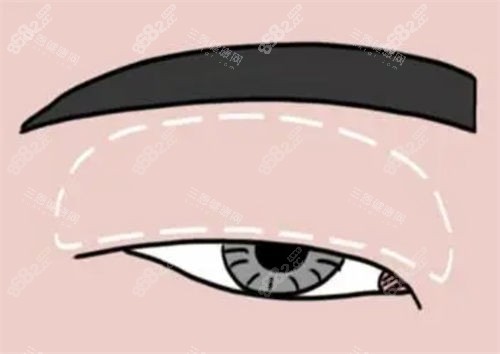 腫眼泡做雙眼皮對(duì)比示意圖