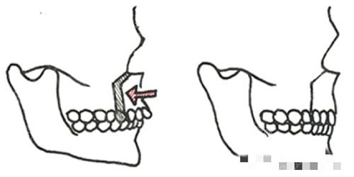 正頜手術(shù)圖片