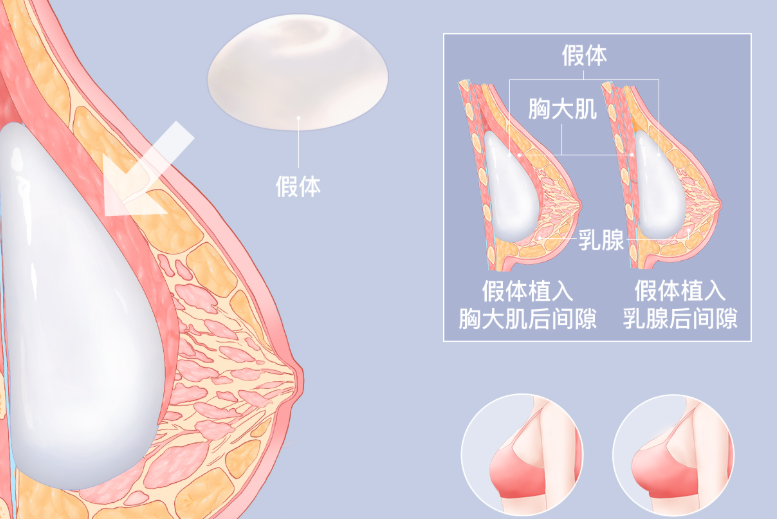 唐欣醫(yī)生與腋下平胸手術(shù)