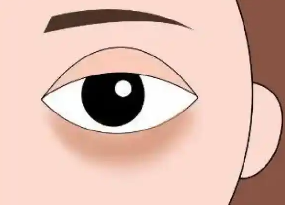 上海朱迪眼袋修復(fù)實例分析