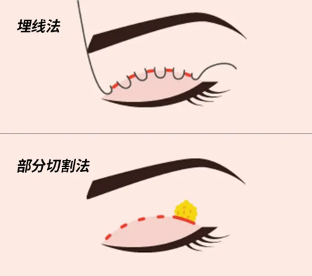 孝感黃清雨做雙眼皮技術(shù)怎么樣？成功實例展示